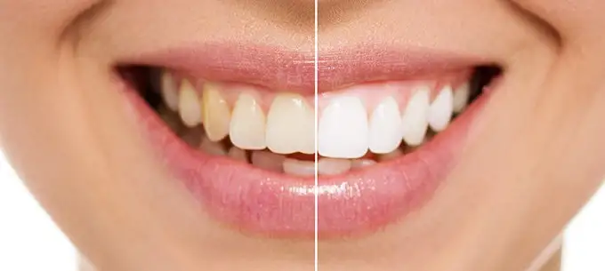 before-after
