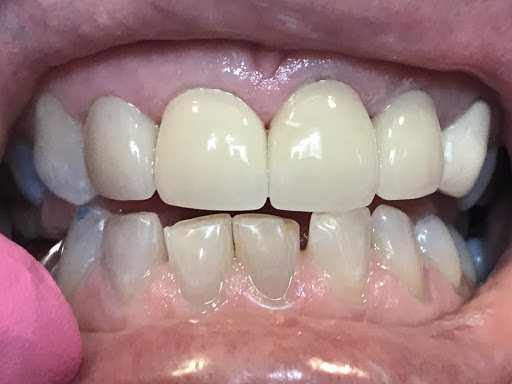 natural teeth color reddit